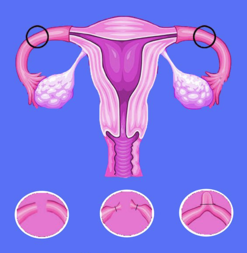 Tubal Ligation